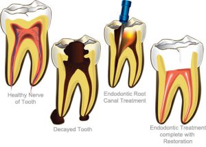 معالجه ریشه دندان